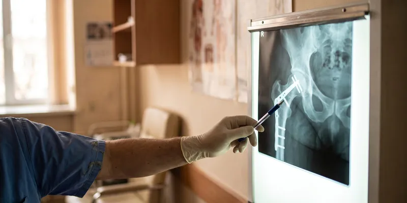 Hip fracture fall injury in NC and the notice rule